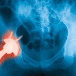 X-ray scan of a hip; a replacement joint is highlighted.