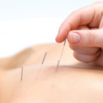 Acupuncture