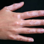 pigment disapearance