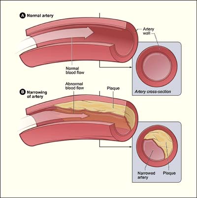 photo_2009_05_13_ather_lowres When coronary arteries are narrowed or blocked by plaque, oxygen-rich blood can't reach the heart muscle and may cause chest pain or a heart attack.