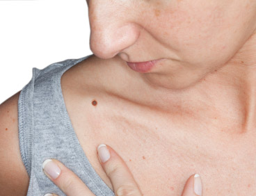 Basic Things We Should Know about Skin Cancer Basic Things We Should Know about Skin Cancer
