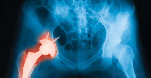 X-ray scan of a hip; a replacement joint is highlighted.