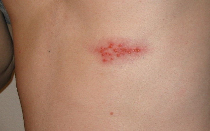 Shingles rash