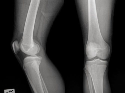 X-ray of legs