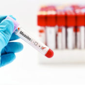 Doctor handling a vial of measles vaccine