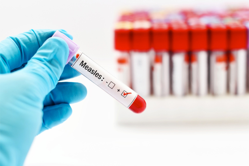 Doctor handling a vial of measles vaccine