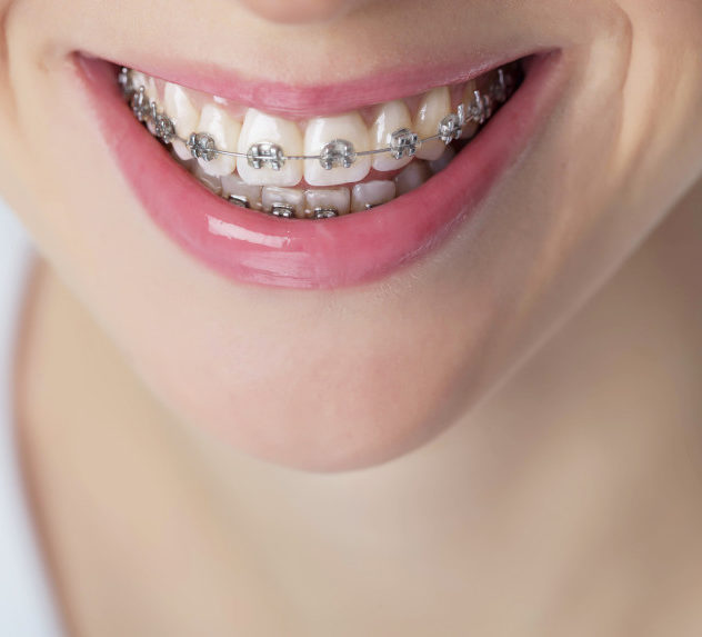 Woman with braces smiling