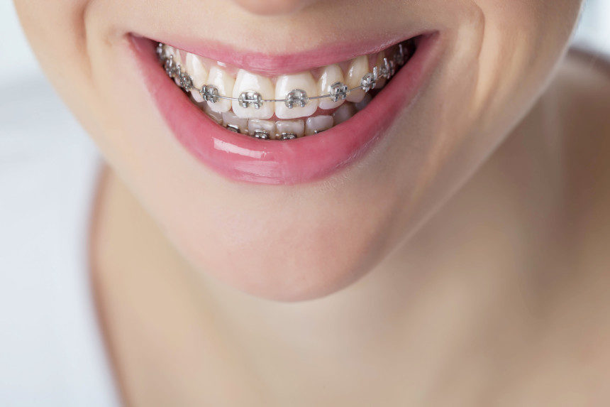 Woman with braces smiling