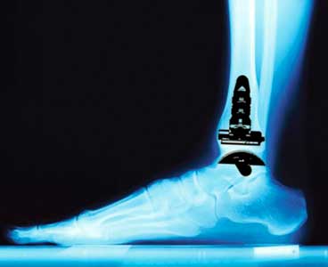 An x-xray of an ankle.