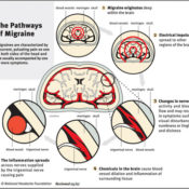 A diagram depicting the different pathways to a migraine.