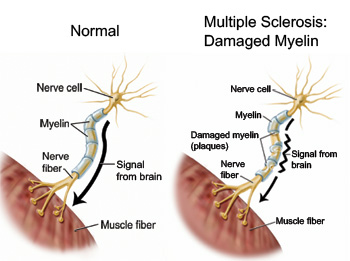 By eating away myelin - the protective nerve coating - MS shorts out the flow of information within the brain and between the brain and body, similar to how a stripped electrical wire can short out an appliance.