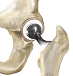 illustration_total_hip_replacement