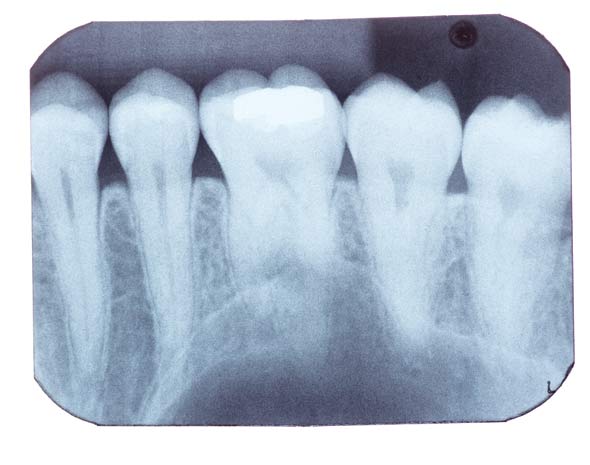 Xray of a mouth
